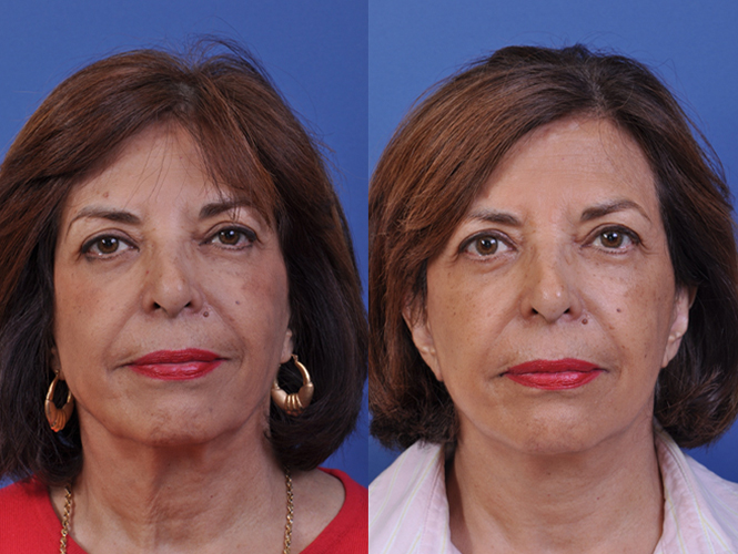 before and after neck liposuction front view female patient case 5014