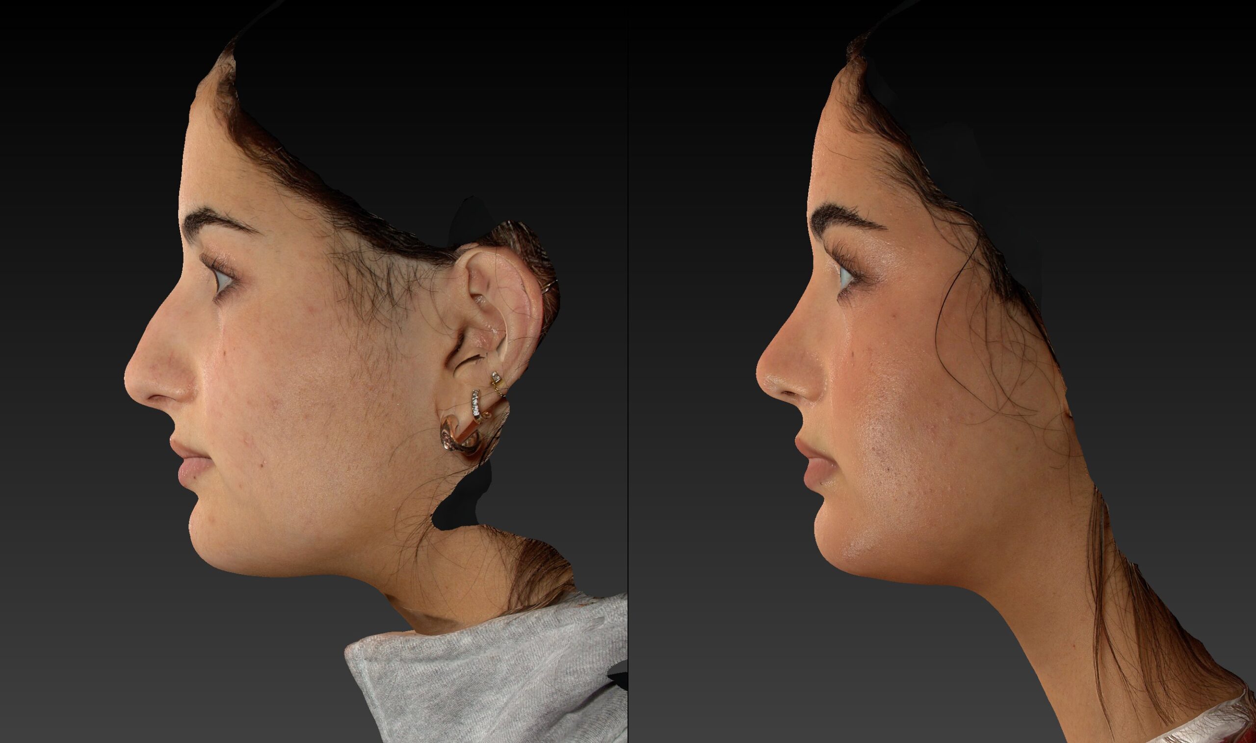 Before and after of rhinoplasty left side view of female patient 6787