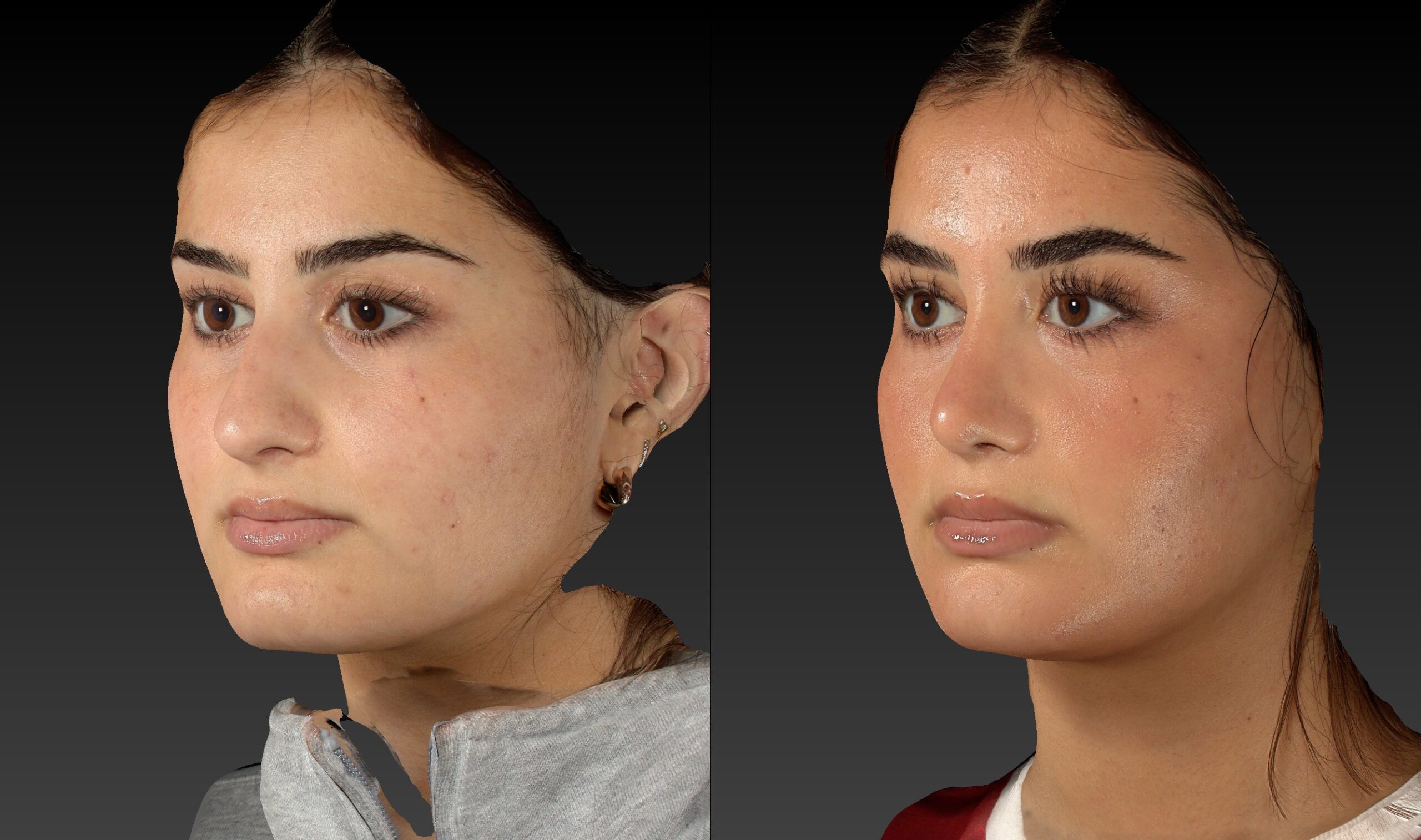 Before and after of rhinoplasty left angle view of female patient 6787