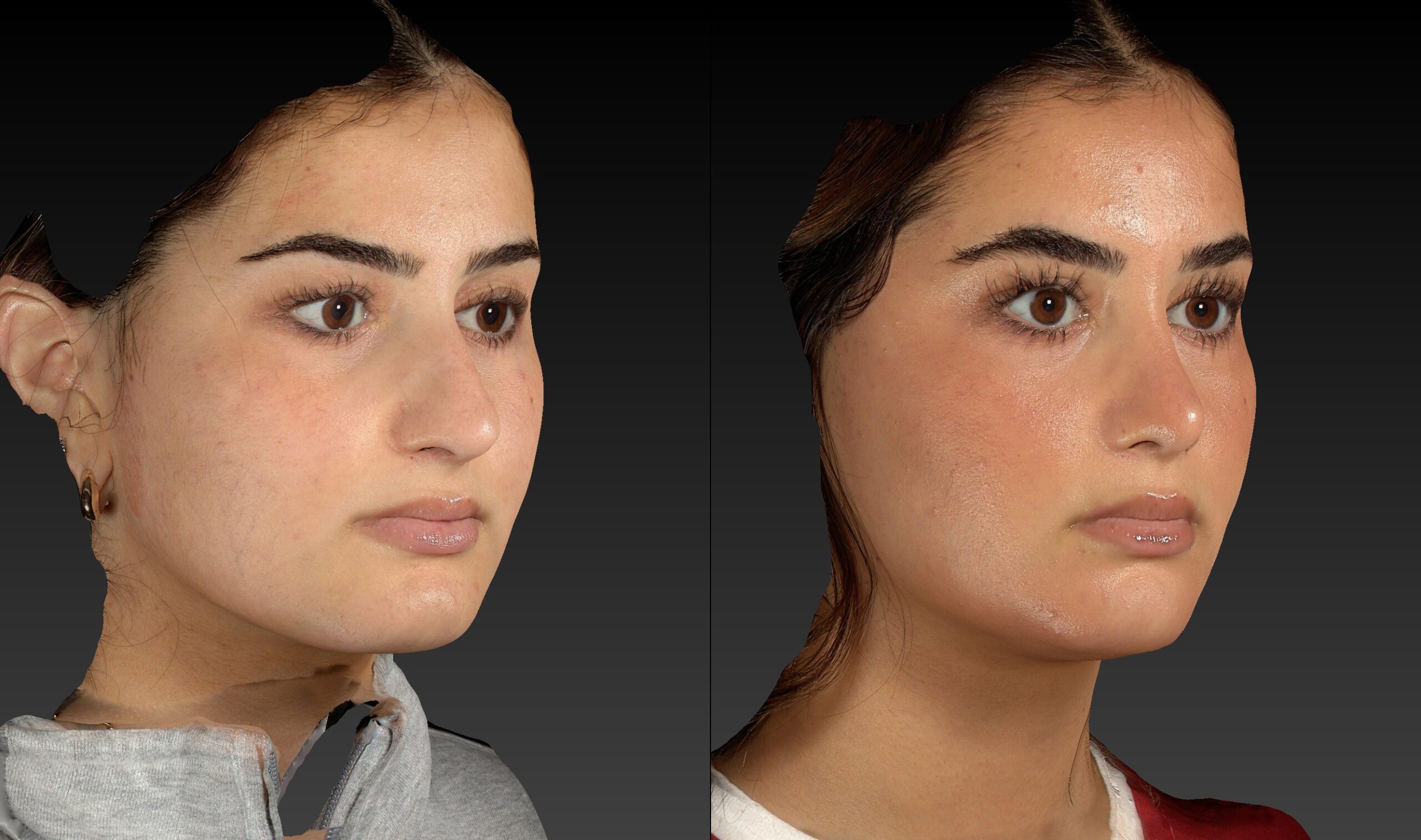 Before and after of rhinoplasty right angle view of female patient 6787
